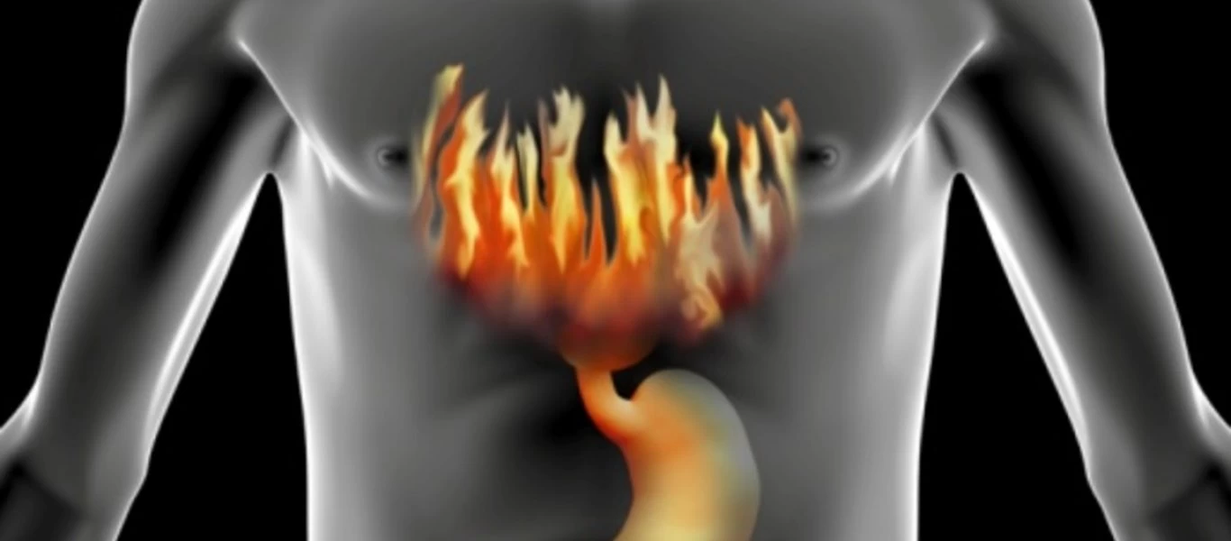 Αυτές είναι οι τροφές που πρέπει να αποφεύγετε αν πάσχετε από καούρες